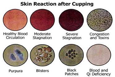 cupping skin reaction guilde
